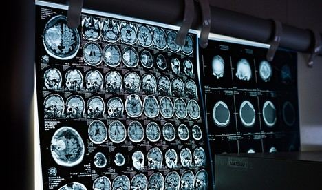 Almería se beneficiará de la nueva terapia ‘TTFields’ para el glioblastoma en hospitales públicos