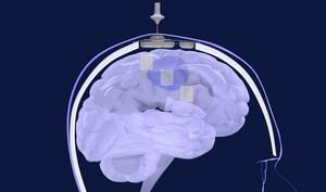 Andalucía se suma a un ensayo pionero contra el glioblastoma cerebral