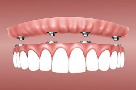Descubre todo lo que hay que saber sobre los implantes dentales