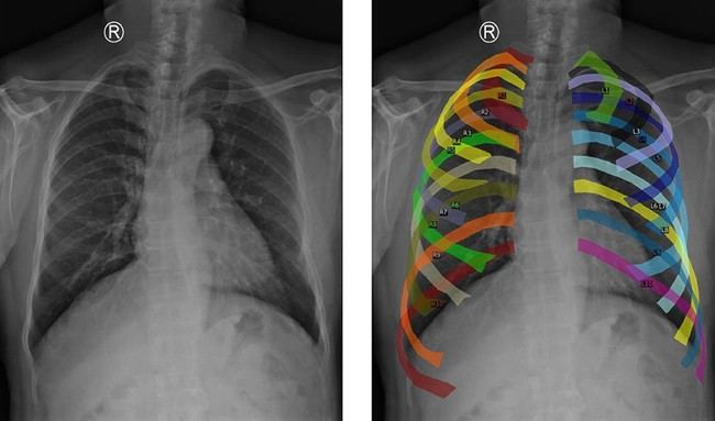 Nuevo modelo de IA mejora diagnóstico de enfermedades pulmonares en Andalucía