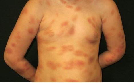 Mastocitosis: Un conjunto de enfermedades raras que afecta a 3.000 personas en España