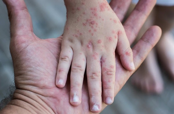 Vera lidera casos de sarampión en Almería con nueve infectados